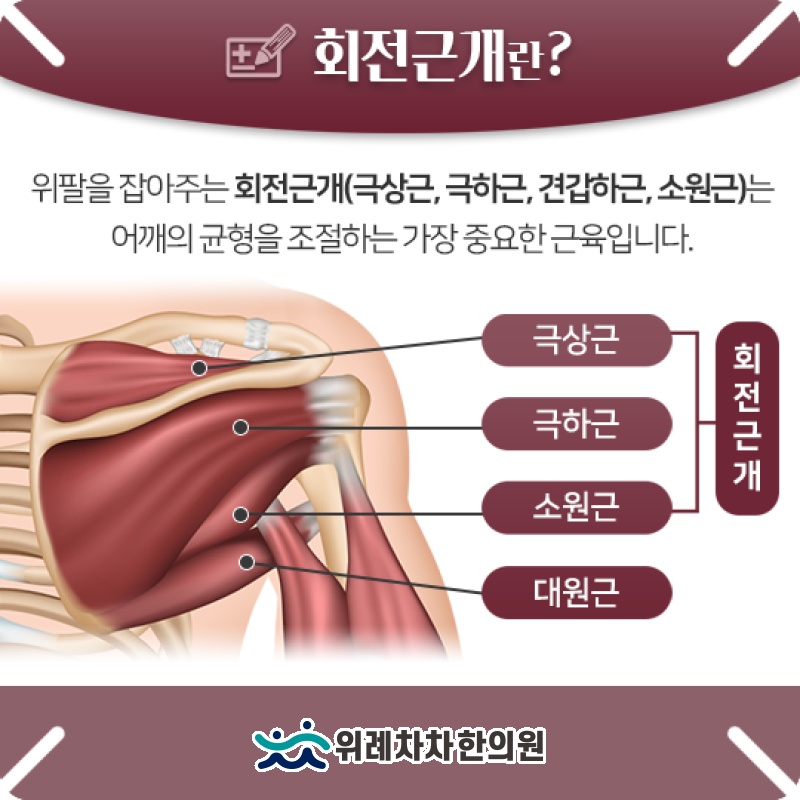 회전근개파열의 주요 증상과 양상별 특징