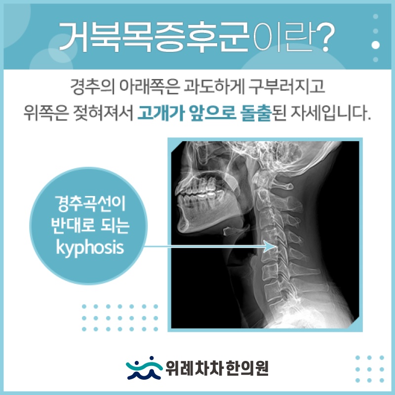 두통과 어지럼, 거북목증후군과의 연관성