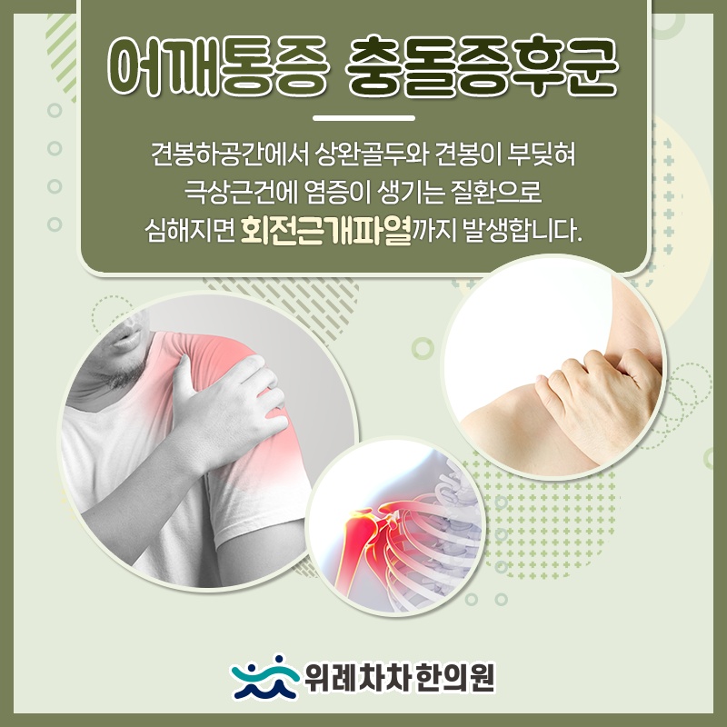 어깨뼈와 팔뼈의 마찰로 생기는 충돌증후군 이해하기