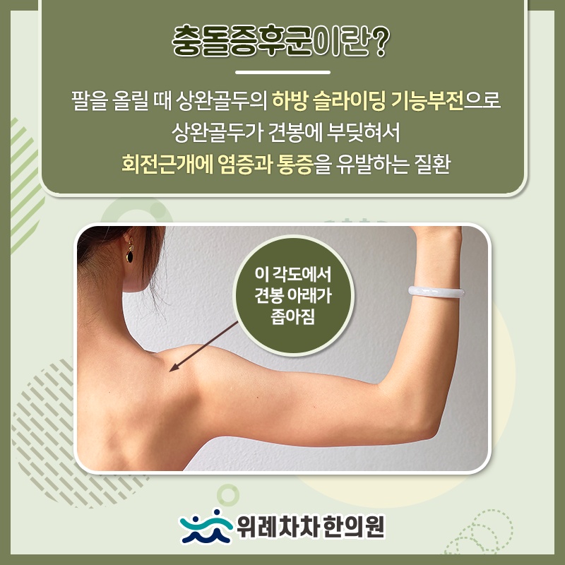 어깨뼈와 팔뼈의 마찰로 생기는 충돌증후군 이해하기