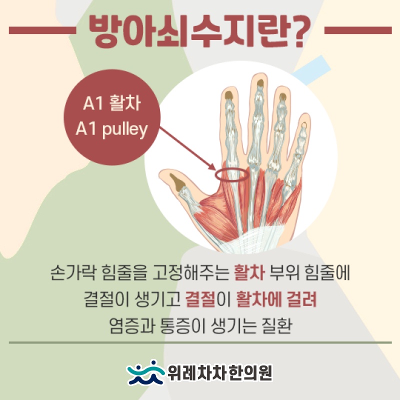 손 질환 중 흔한 방아쇠수지의 발생 특징