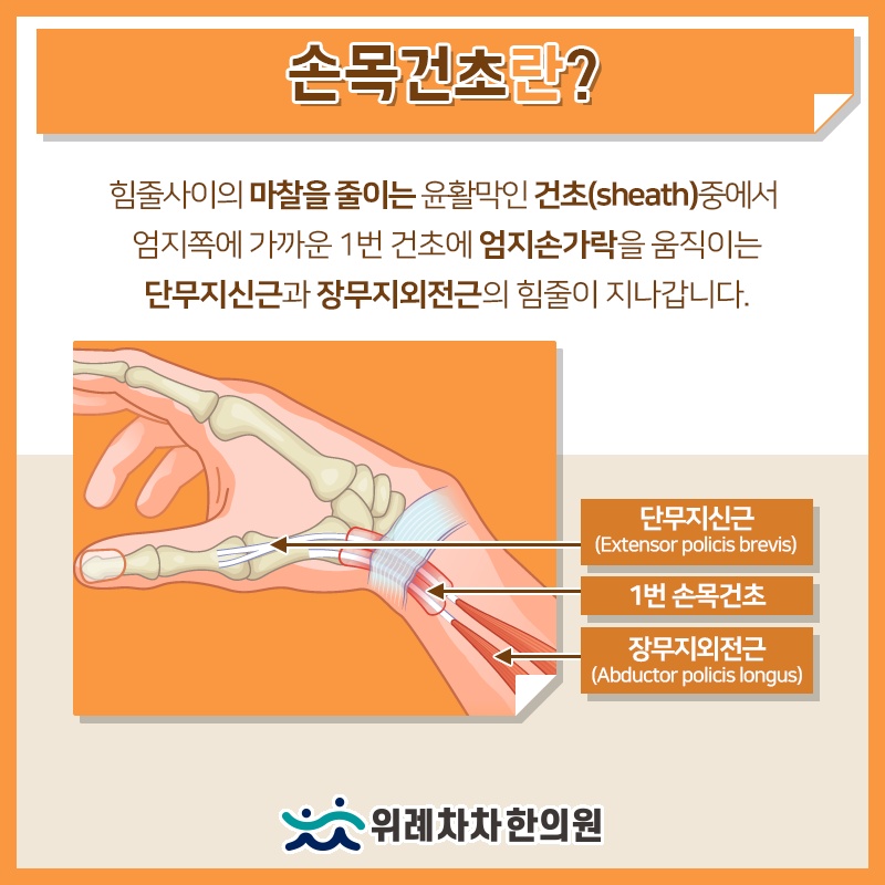 손목 통증과 움직임 변화로 알아보는 손목건초염 신호