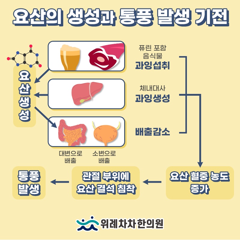 갑작스러운 관절 통증으로 나타나는 통풍의 주요 양상